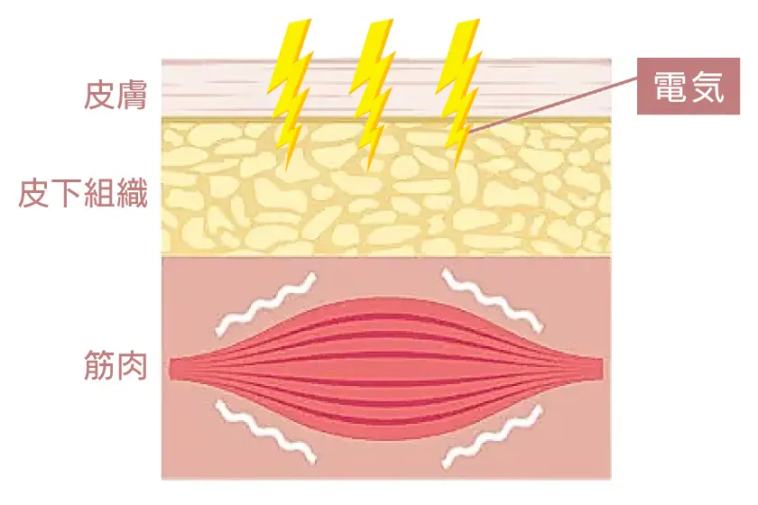 EMSで骨盤底筋トレーニング